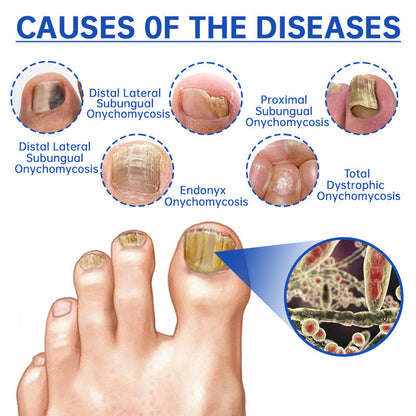 ✨Last Day Discount -70%OFF✨QIAWI™ PureNail Fungus Laser Device-🗽Made and Shipped from USA👏