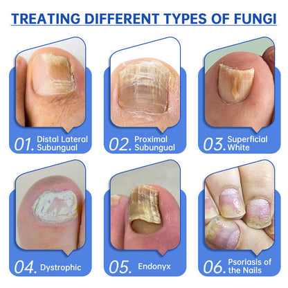 ✨Last Day Discount -70%OFF✨QIAWI™ PureNail Fungus Laser Device-🗽Made and Shipped from USA👏