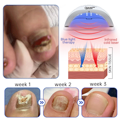 ✨Last Day Discount -70%OFF✨QIAWI™ PureNail Fungus Laser Device-🗽Made and Shipped from USA👏